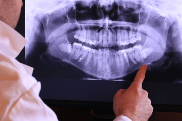 Best Dental Abscess Treatment in Spring Valley Lake, CA
