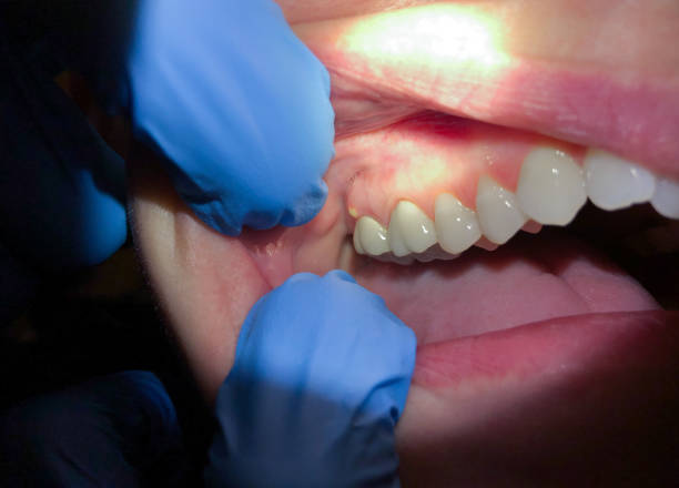 Best Broken or Chipped Tooth Repair in Spring Valley Lake, CA